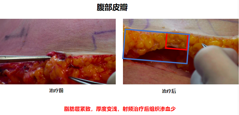 吸脂减肥疼吗_吸脂减肥的价格受多个因素影响