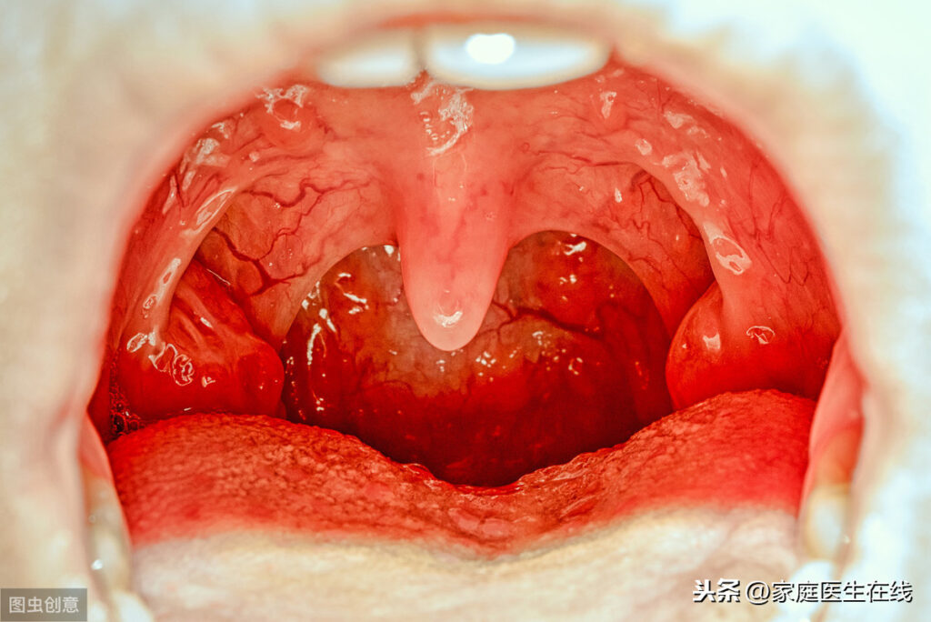 急性扁桃体炎的症状有哪些_如何预防急性扁桃体炎