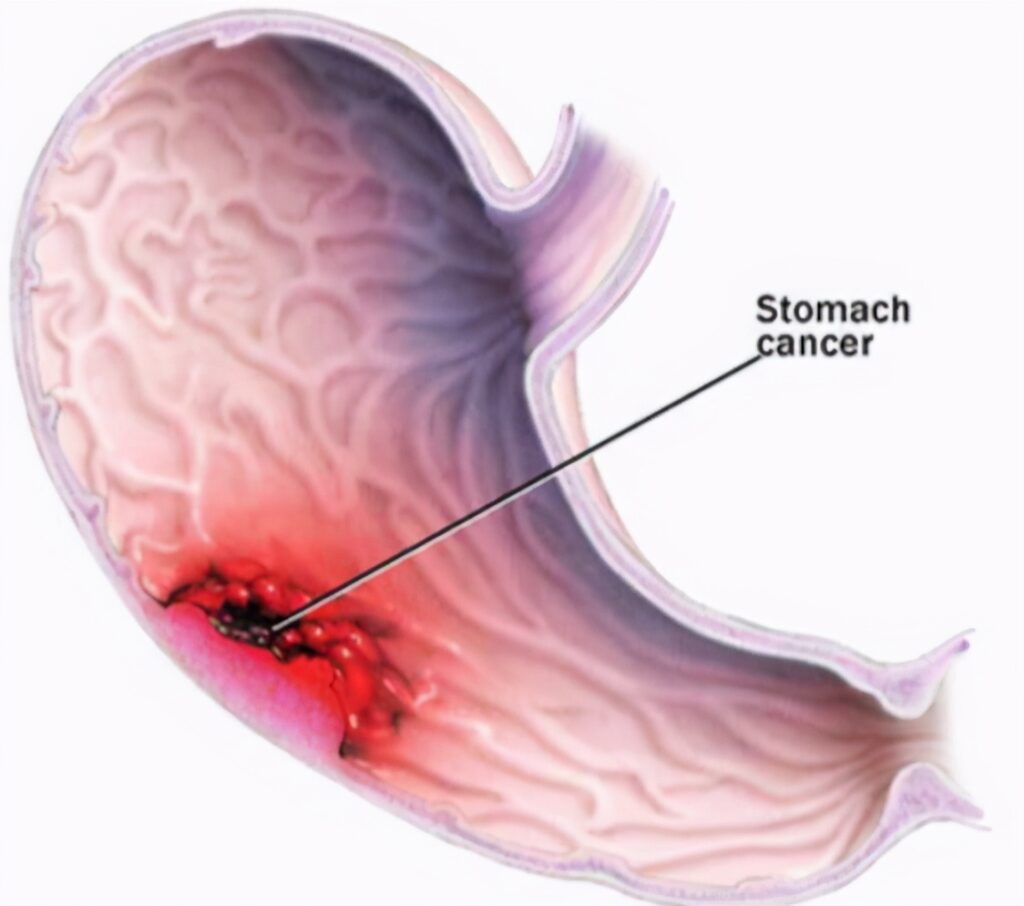 胃癌有哪些标志物_胃癌五大肿瘤标志物