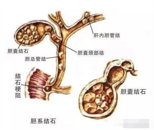 结石到底是什么东西_结石是怎么形成的