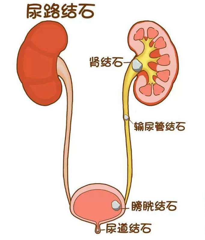 尿路结石疼痛位置图片