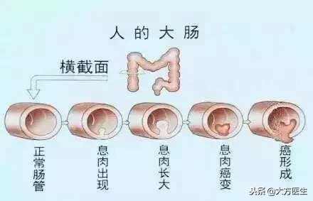 导致大肠癌的原因是什么(了解大肠癌发病的4种原因)