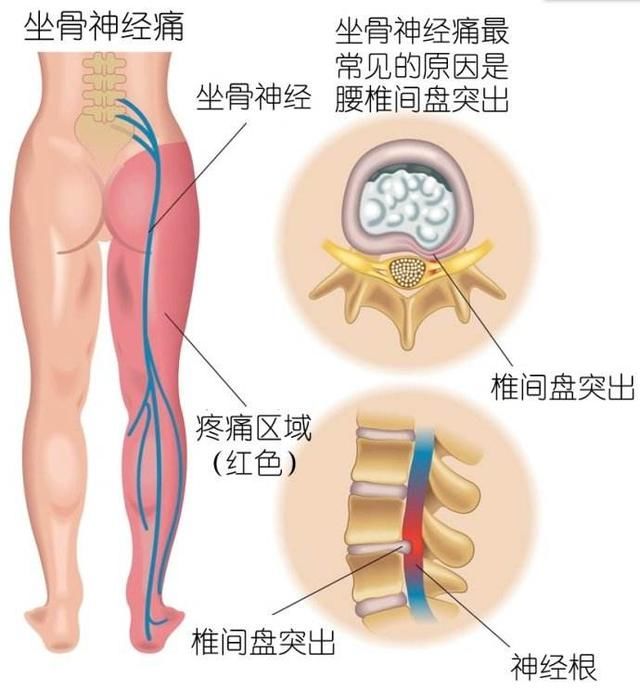 小腿肚酸胀是什么原因引起的(小腿肚酸胀常见的病因)