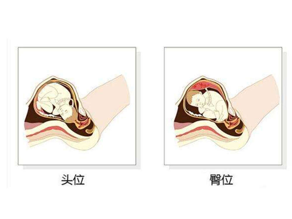 为什么会形成胎儿臀位