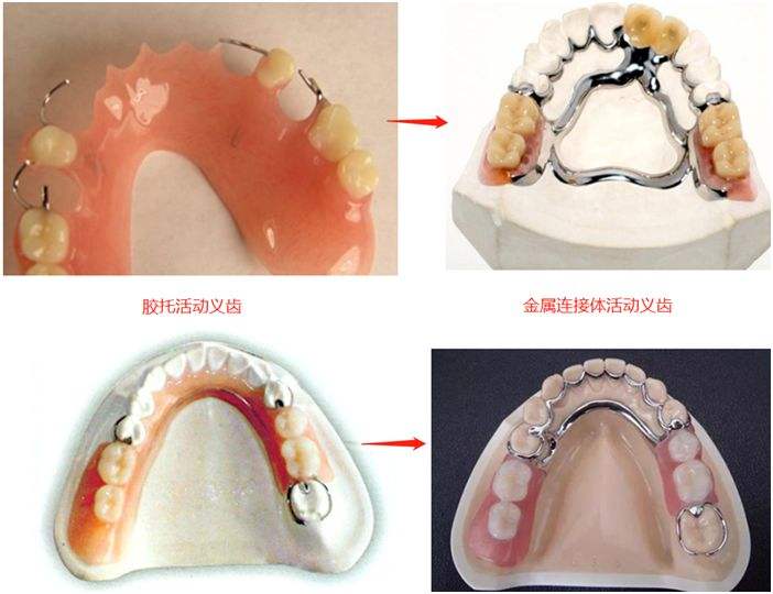 中老年人更适合哪一种假牙_3种假牙修复优缺点