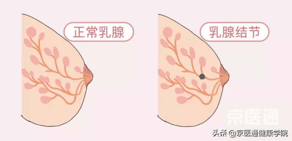 用手摸怎么确认是乳腺增生结节_本文教您怎么分辨