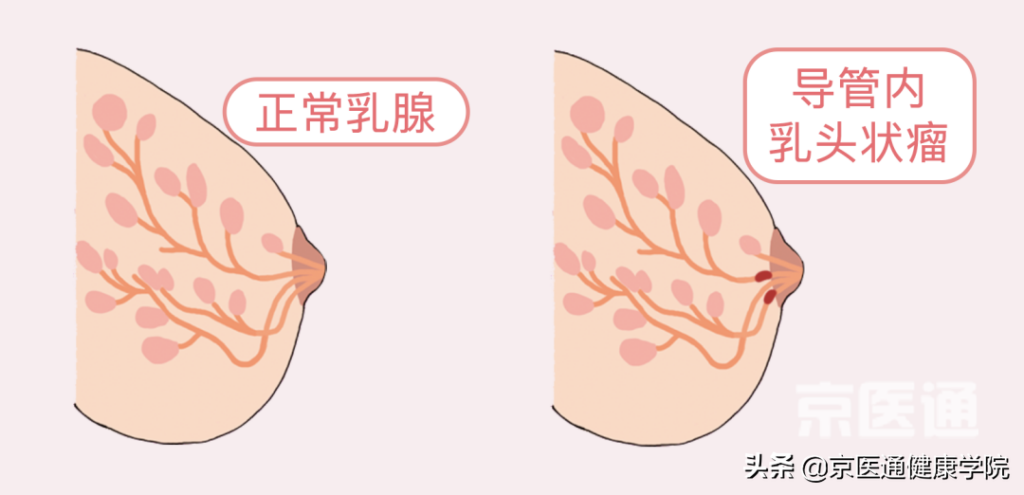 用手摸怎么确认是乳腺增生结节_本文教您怎么分辨