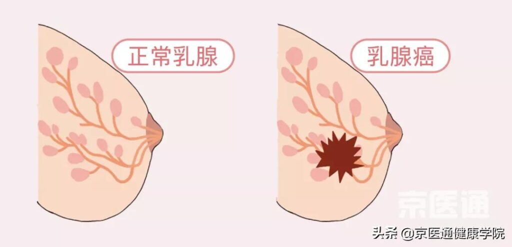 用手摸怎么确认是乳腺增生结节_本文教您怎么分辨