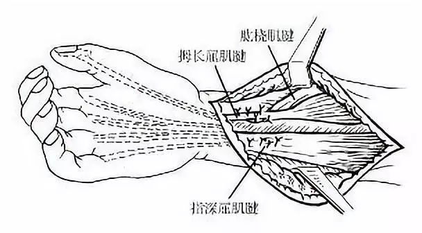 正中神经损伤怎么治疗_正中神经损伤康复训练