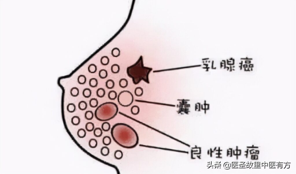 乳腺增生吃什么药最好_轻度乳腺增生吃什么药最好