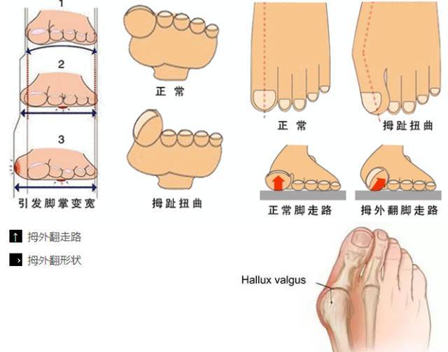 大脚趾外翻有什么危害_大脚趾外翻对身体有什么影响