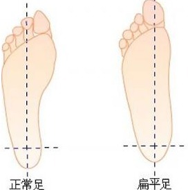 大脚趾外翻有什么危害_大脚趾外翻对身体有什么影响