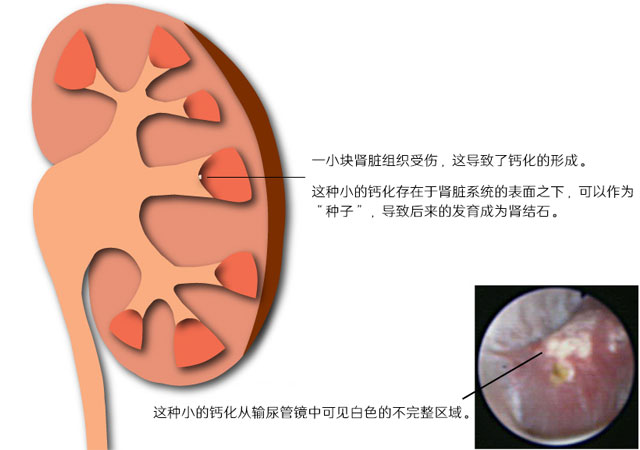 肾结晶是什么_肾结晶形成的食物来源