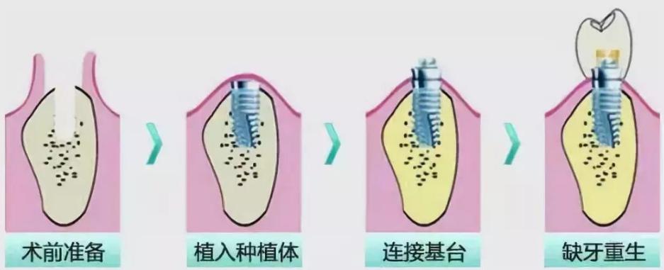 种牙时间长吗_种牙会疼吗