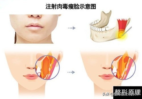 瘦脸针反弹吗_瘦脸针还会反弹吗