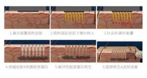 怎样消除妊娠纹_妊娠纹怎么消除