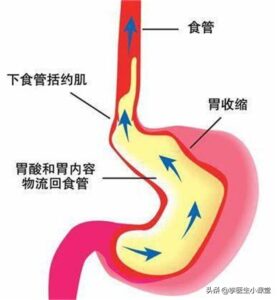 什么是胃食管返流_胃食管返流的治疗