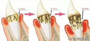 牙周炎如何治疗_治疗牙周炎的常见方式