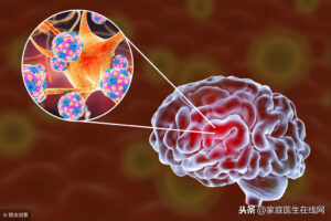 脑炎是怎么回事_脑炎的症状