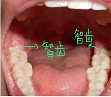 智齿一般什么时候长_智齿什么年龄段长