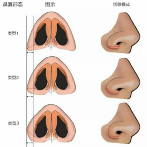 鼻子鼻翼大怎么办_鼻翼肥大如何改善