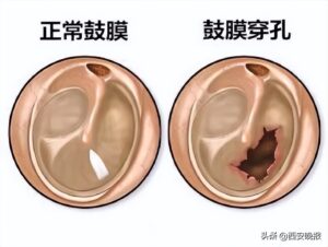 男子打蚊子把自己左耳鼓膜打穿孔