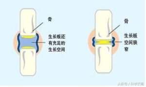 骨骺线怎么判断是否闭合_判断骨骺线是否闭合的方法