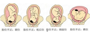 胎位不正怎么纠正_胎位不正纠正方法