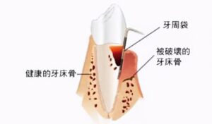 牙齿有点松动怎么办_治疗松动牙齿的方法