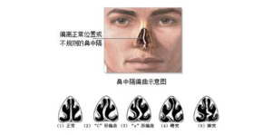 鼻梁歪了会怎么样_鼻梁有些歪怎么办