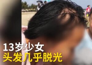 女学生频繁掉发索性剃成光头