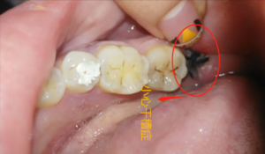 拔一颗牙多少钱_拔一颗智齿多少钱