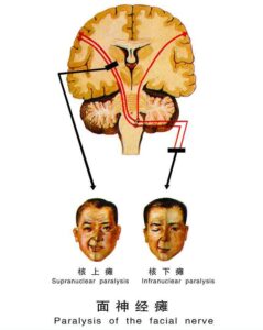 面瘫的发病原因_面瘫的临床表现