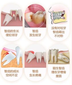 拔牙多少钱一颗_拔一颗牙多少钱