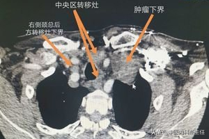 如何自测是否是甲状腺癌_甲状腺疾病的7大类