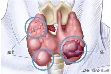 如何自测是否是甲状腺癌_甲状腺疾病的7大类