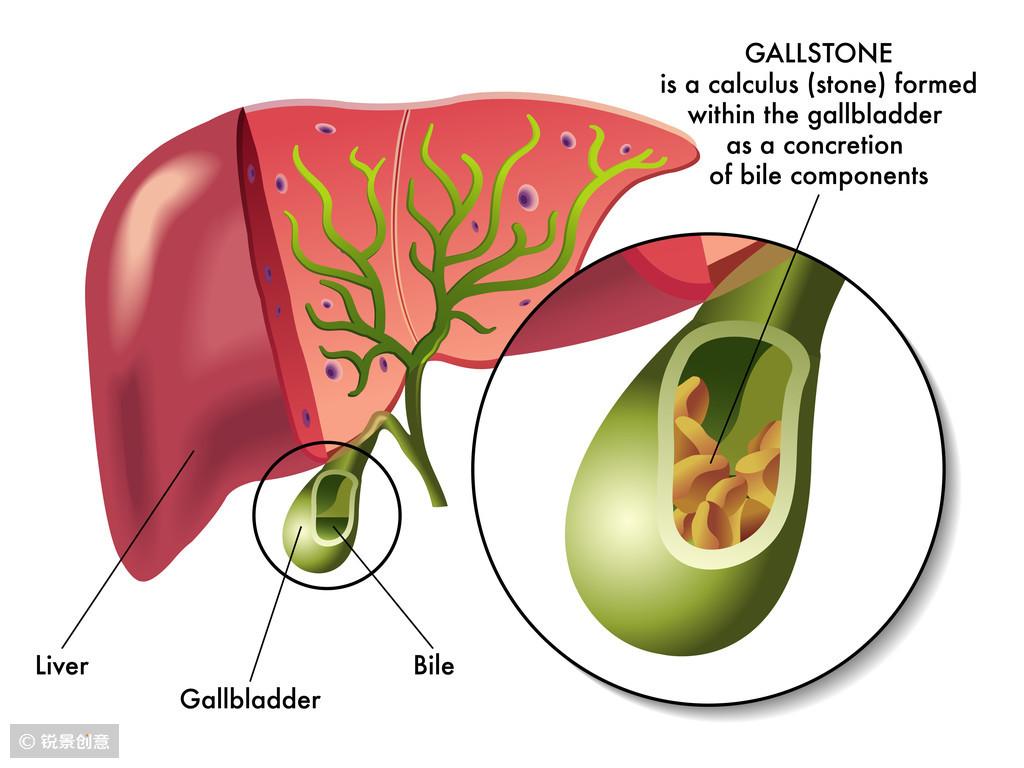 胆结石如何选择治疗方案_胆结石术后会产生后遗症吗