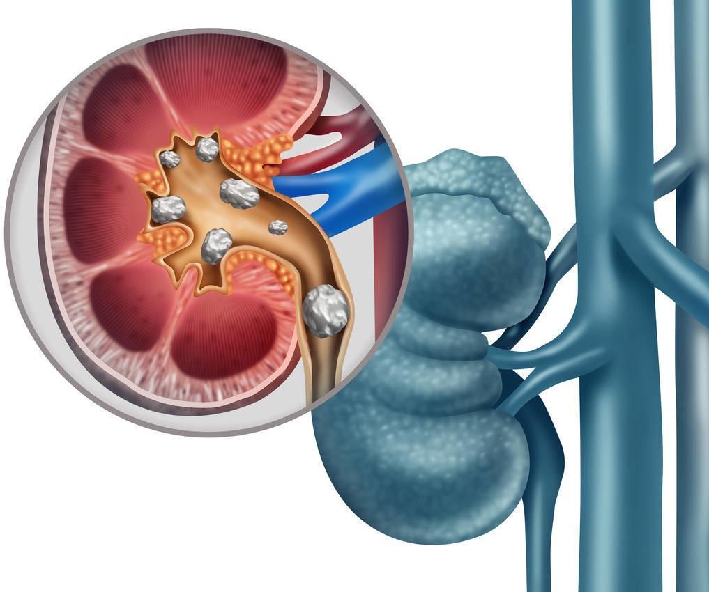 啤酒对结石的作用_肾结石的病因