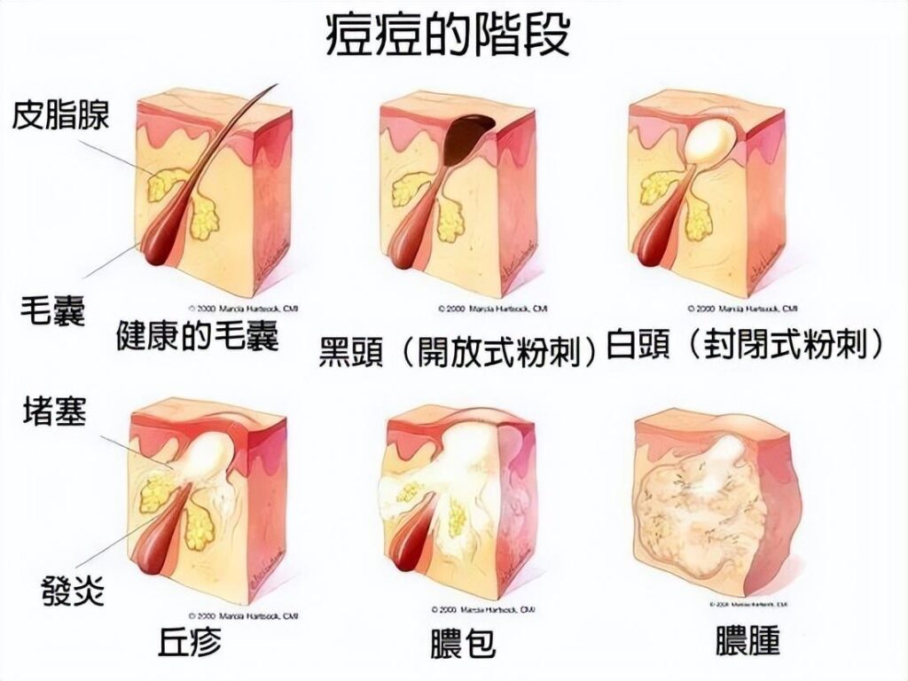 水杨酸祛痘痘好用吗_为什么刷水杨酸能去黑头痘痘