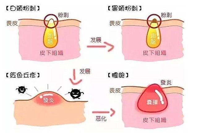 为什么会长粉刺_什么是闭口粉刺