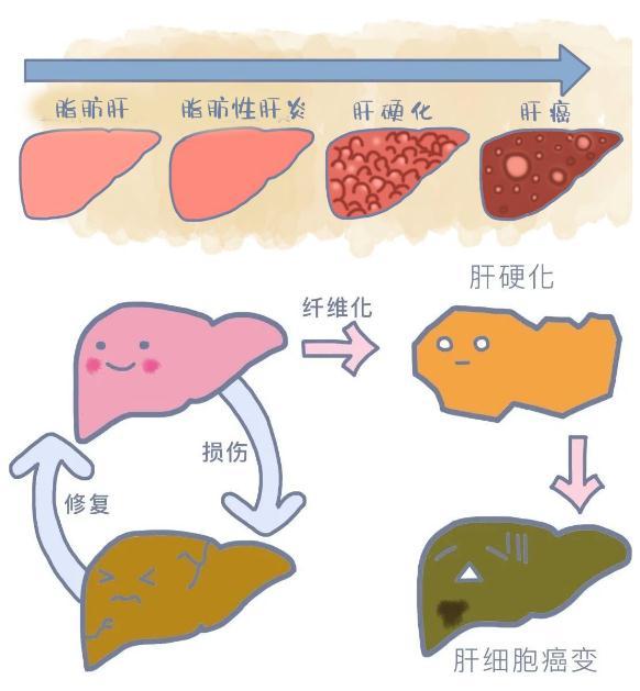 脂肪肝有哪些症状_如何发现早期脂肪肝