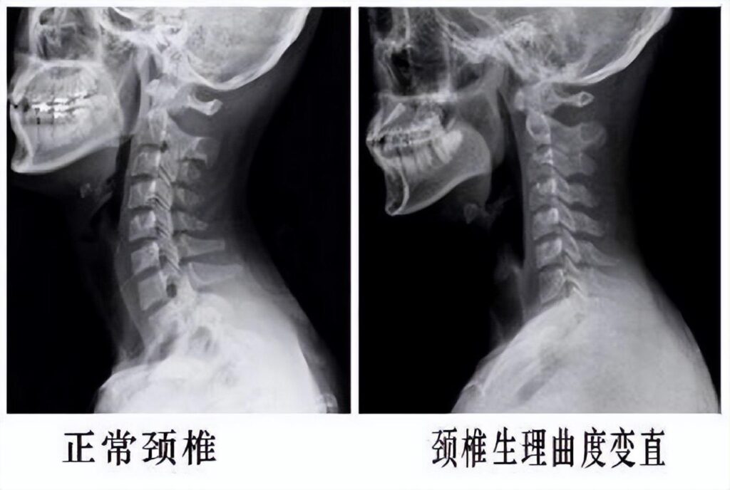 什么原因导致上交叉综合征_导致上交叉综合征的原因