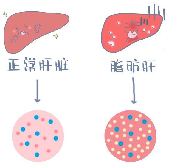 脂肪肝有哪些症状_如何发现早期脂肪肝