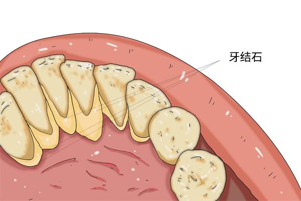 牙结石是怎么来的_牙结石的形成和改善