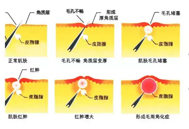 鸡皮肤怎么形成的_鸡皮肤形成的原因