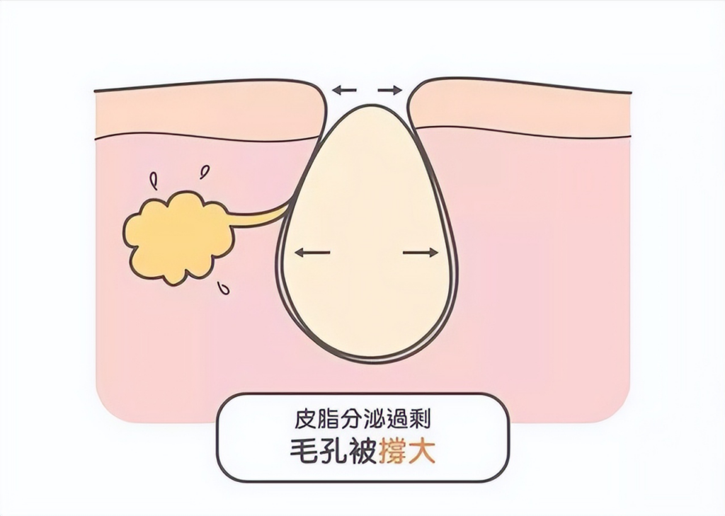 毛孔粗大怎么解决_毛孔粗大的原因和解决