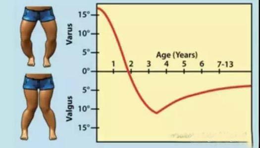 什么是X型腿_什么样的腿才是正常的