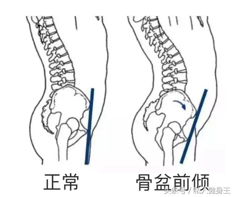 骨盆前倾怎么办_骨盆前倾的特点