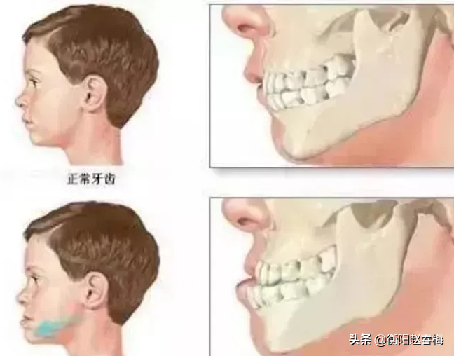 什么是地包天_地包天的形成原因