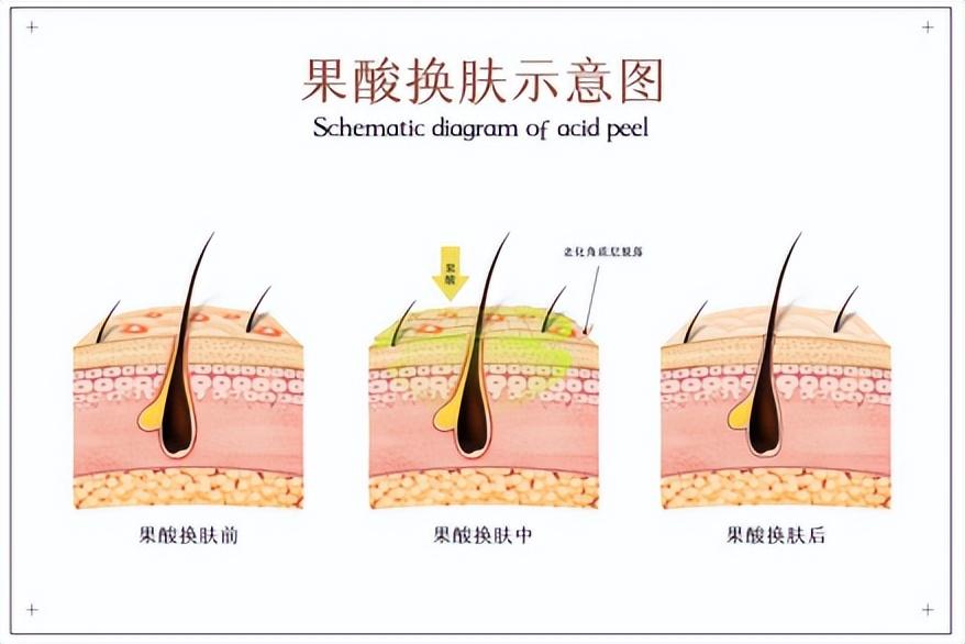 什么是果酸_果酸有哪些作用